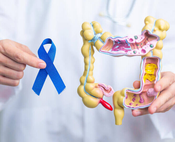 Colorectal Cancer Tampa FL