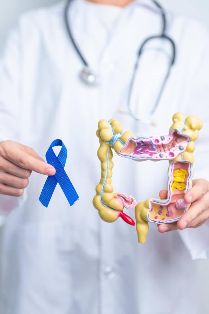 Colorectal Cancer Tampa FL